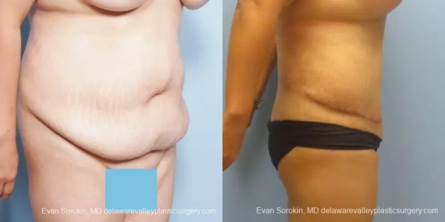 Philadelphia Abdominoplasty 8678 - Before and After 5