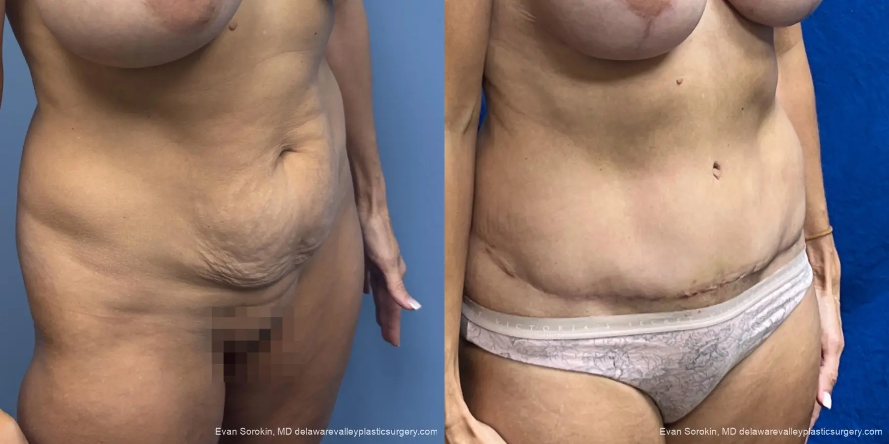 Abdominoplasty: Patient 44 - Before and After 2