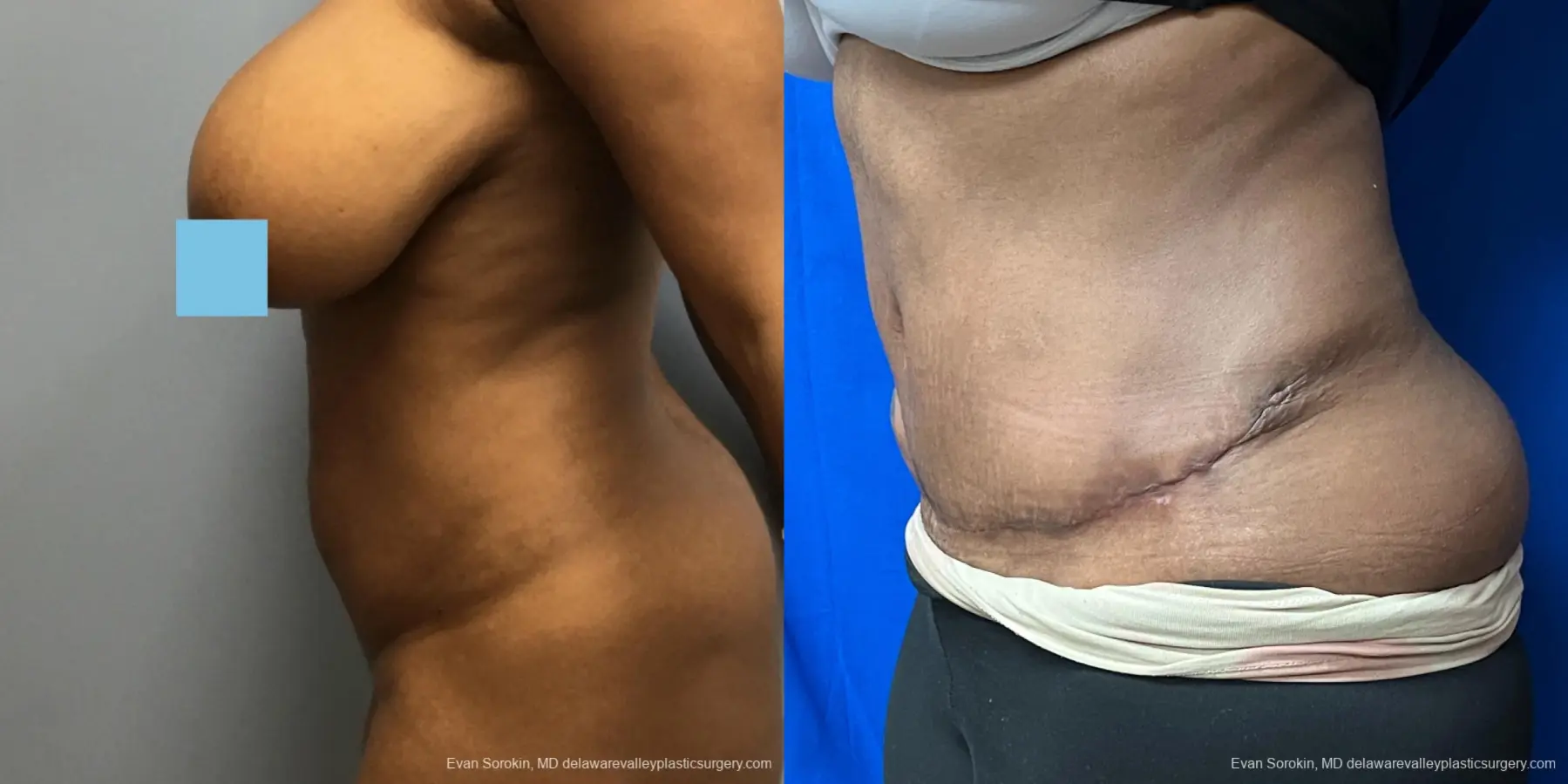Abdominoplasty: Patient 39 - Before and After 5