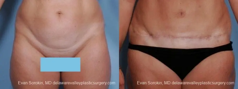Philadelphia Abdominoplasty 8682 - Before and After 1