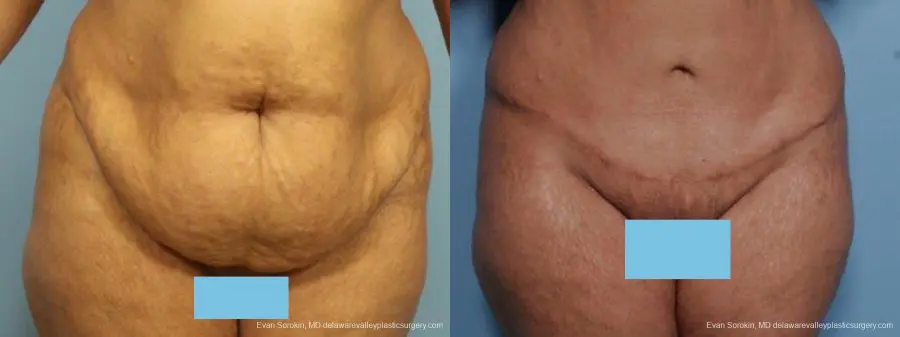 Philadelphia Abdominoplasty 9462 - Before and After 1