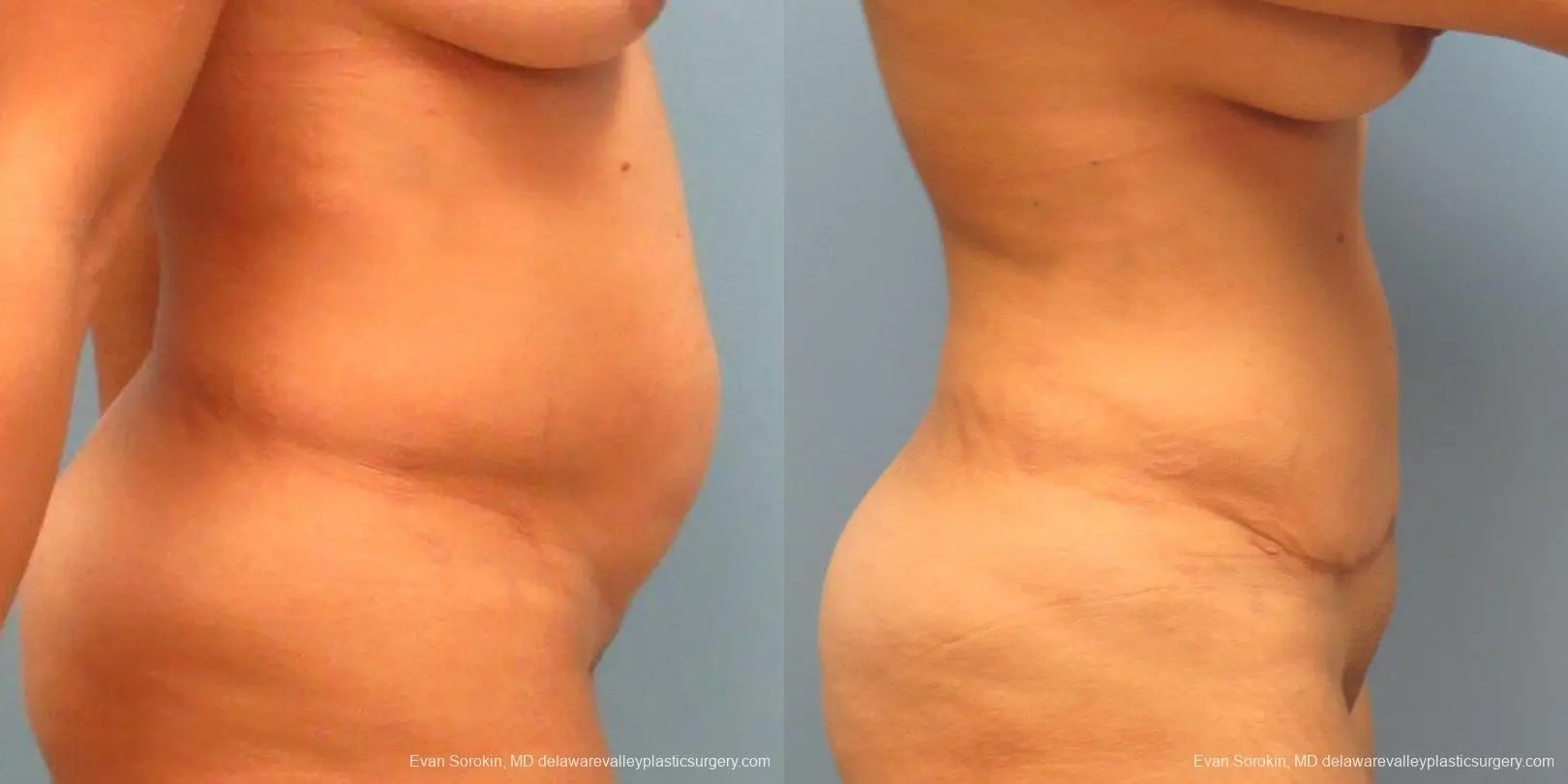 Philadelphia Abdominoplasty 9478 - Before and After 5