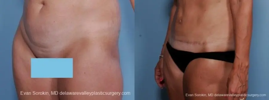 Philadelphia Abdominoplasty 8682 - Before and After 3