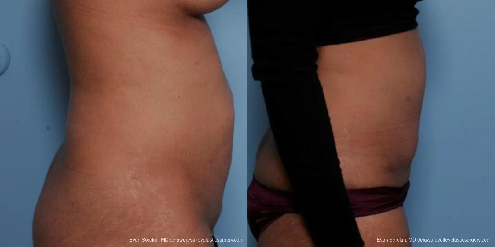 Philadelphia Abdominoplasty 9479 - Before and After 3