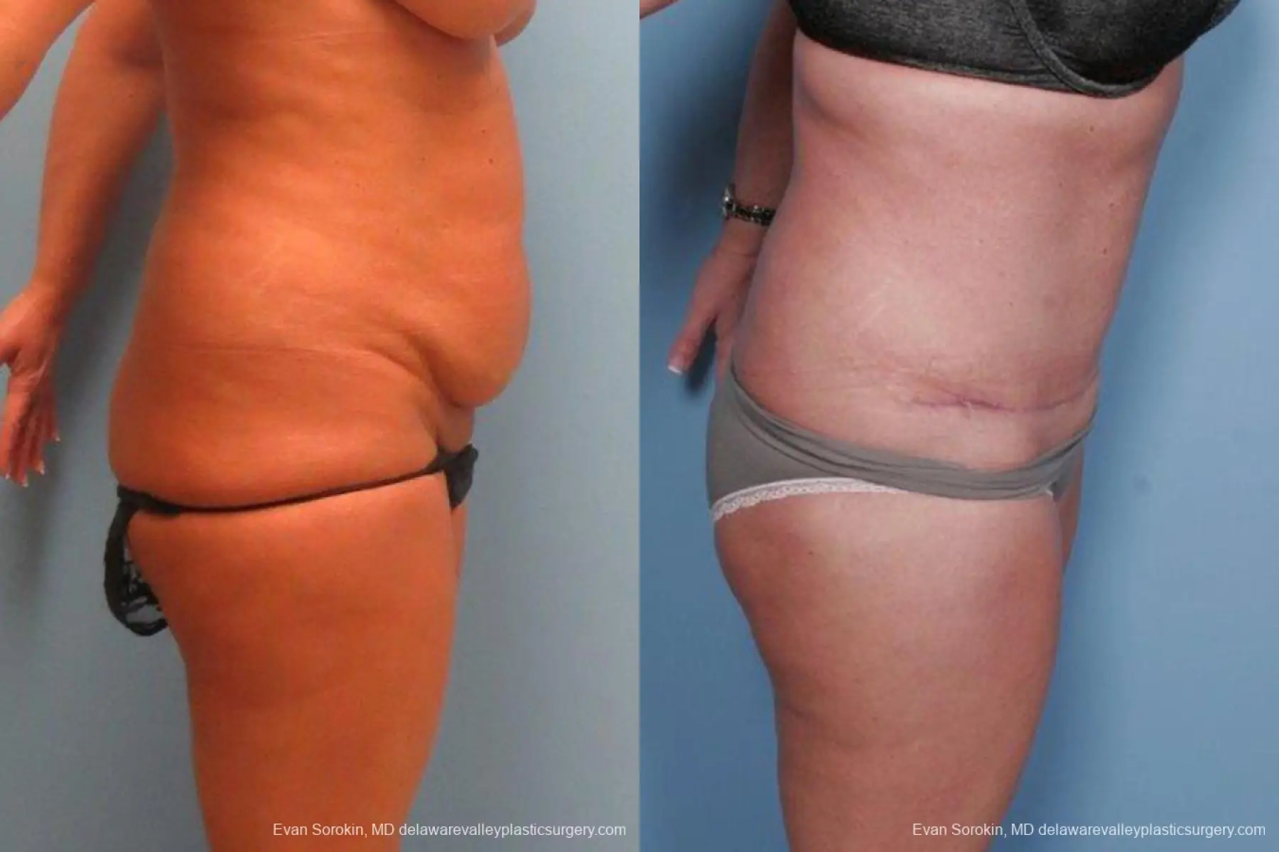 Philadelphia Abdominoplasty 9463 - Before and After 3