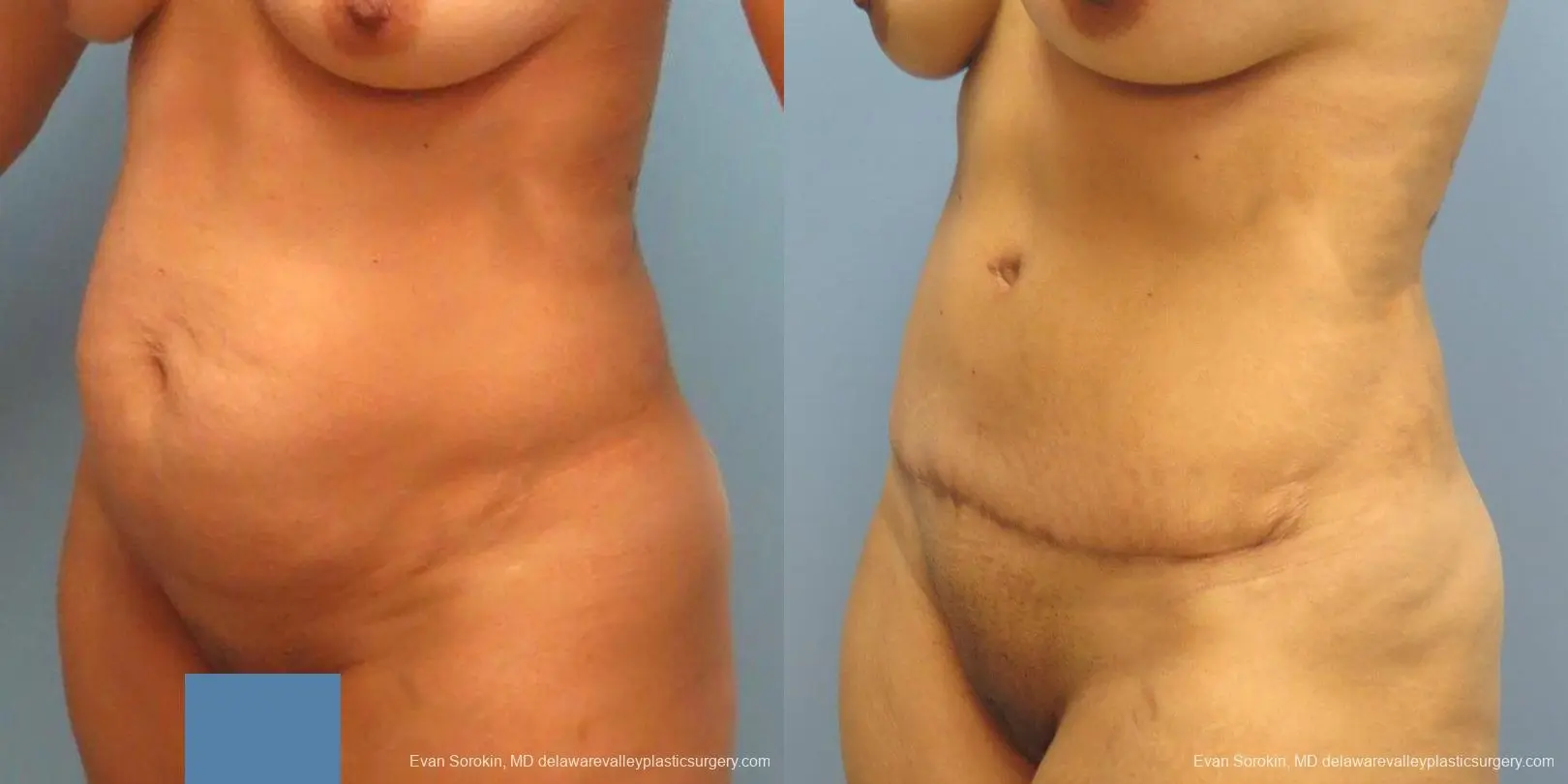 Philadelphia Abdominoplasty 9478 - Before and After 2