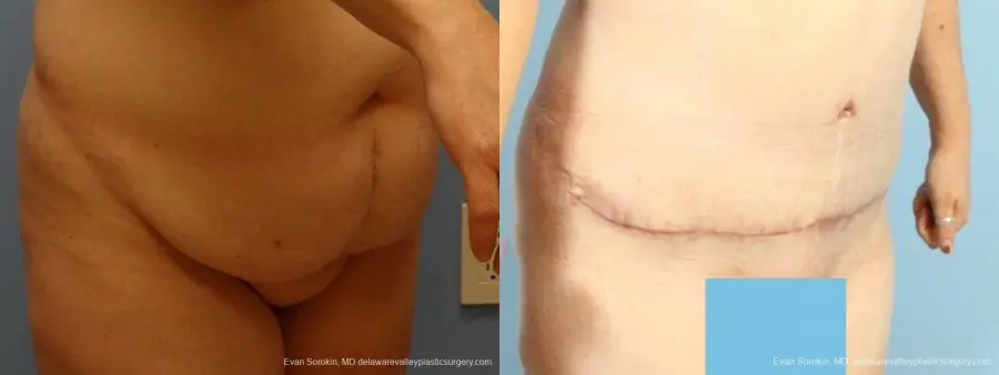 Philadelphia Abdominoplasty 9467 - Before and After 2