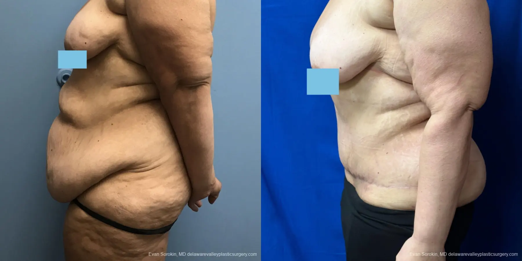 Abdominoplasty: Patient 37 - Before and After 4