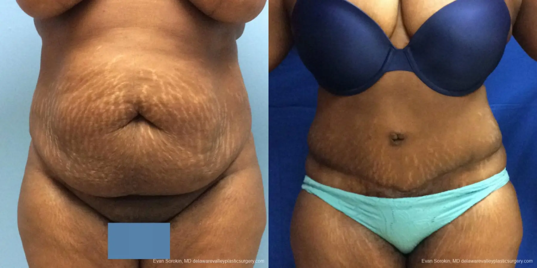 Philadelphia Abdominoplasty 10817 - Before and After 1