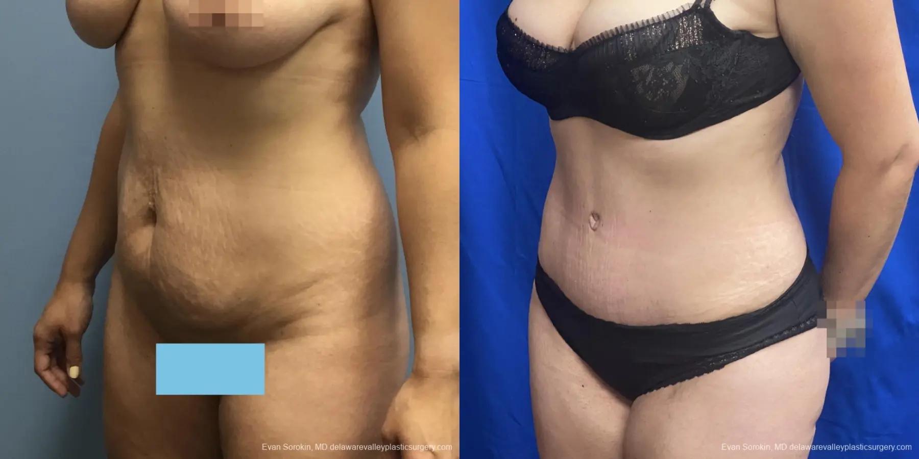 Abdominoplasty: Patient 35 - Before and After 4