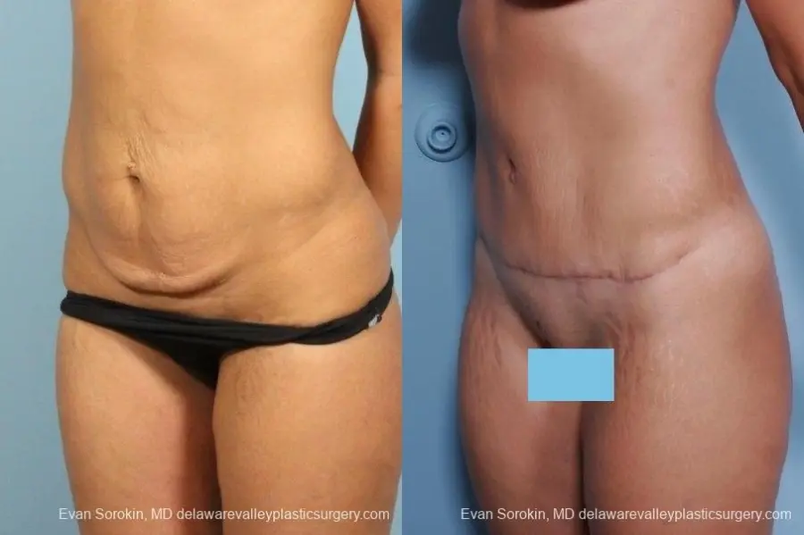 Philadelphia Abdominoplasty 8698 - Before and After 2