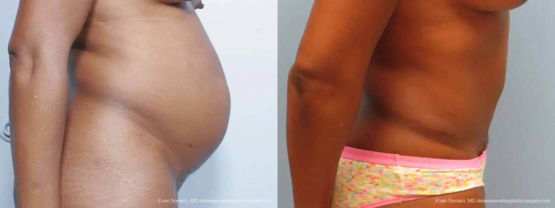 Philadelphia Abdominoplasty 9339 - Before and After 3