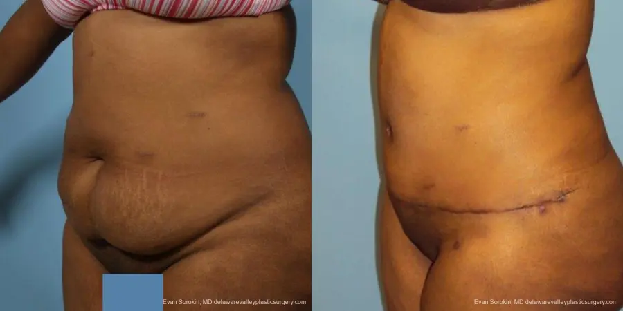 Philadelphia Abdominoplasty 9472 - Before and After 4