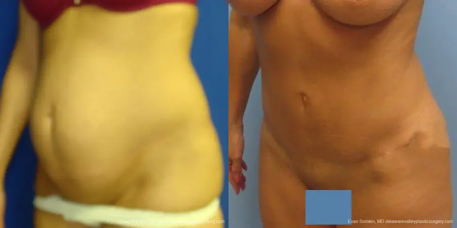 Philadelphia Abdominoplasty 9475 - Before and After 4