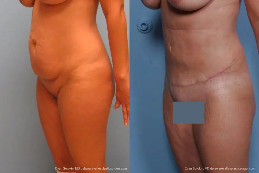 Philadelphia Abdominoplasty 9460 - Before and After 4
