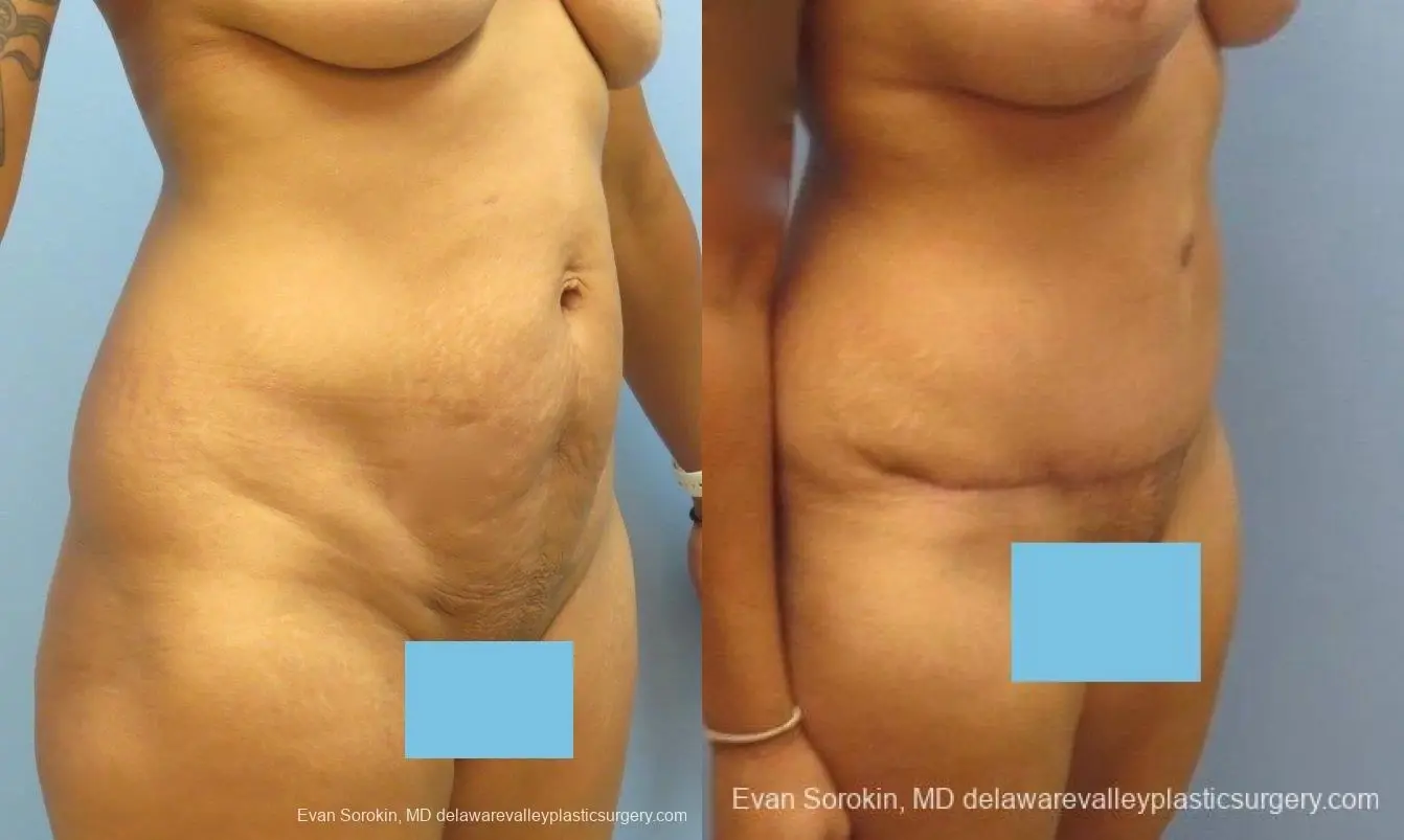 Philadelphia Abdominoplasty 8825 - Before and After 2