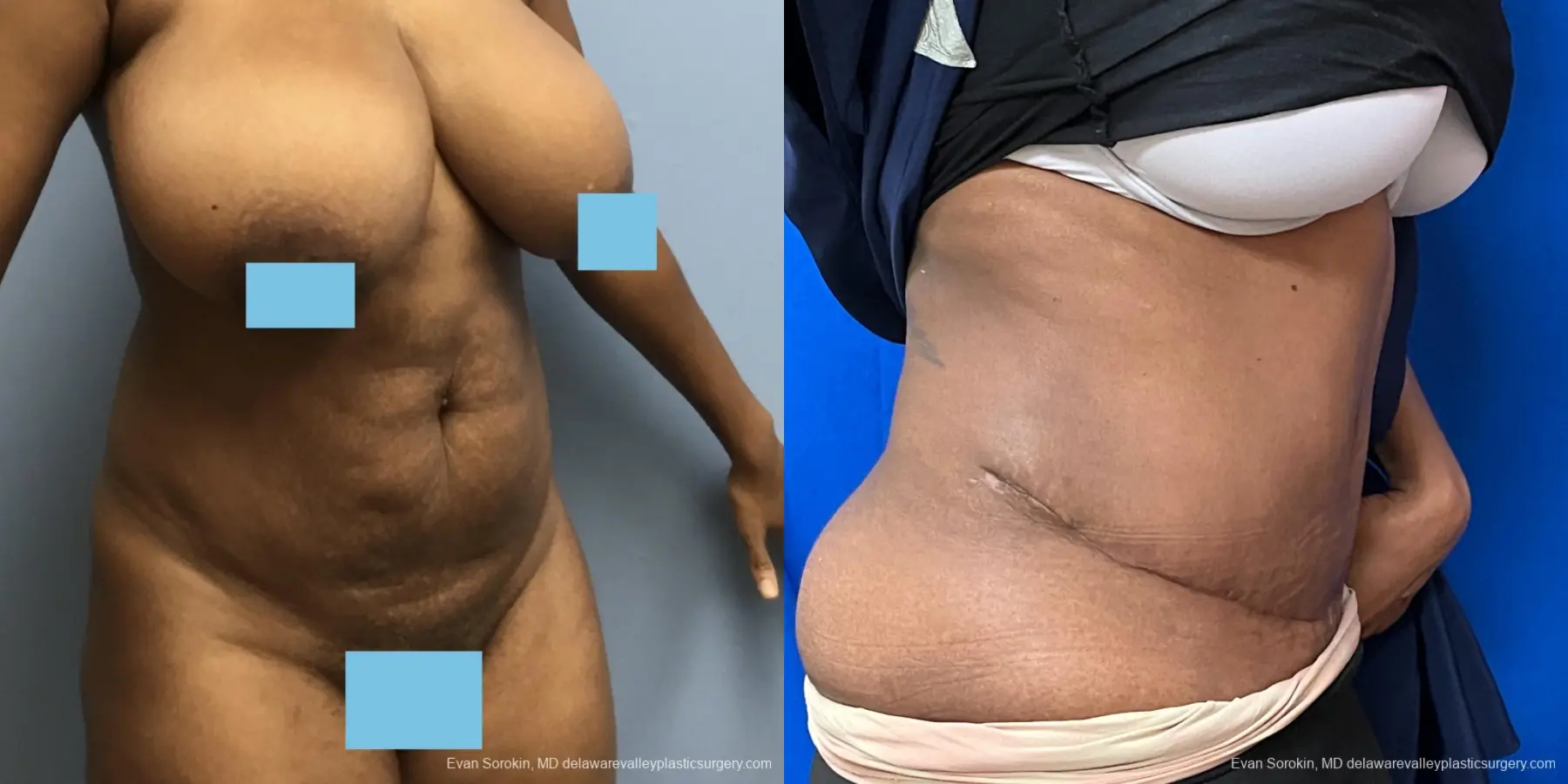 Abdominoplasty: Patient 39 - Before and After 2