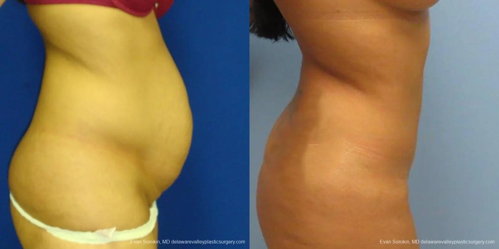 Philadelphia Abdominoplasty 9475 - Before and After 3