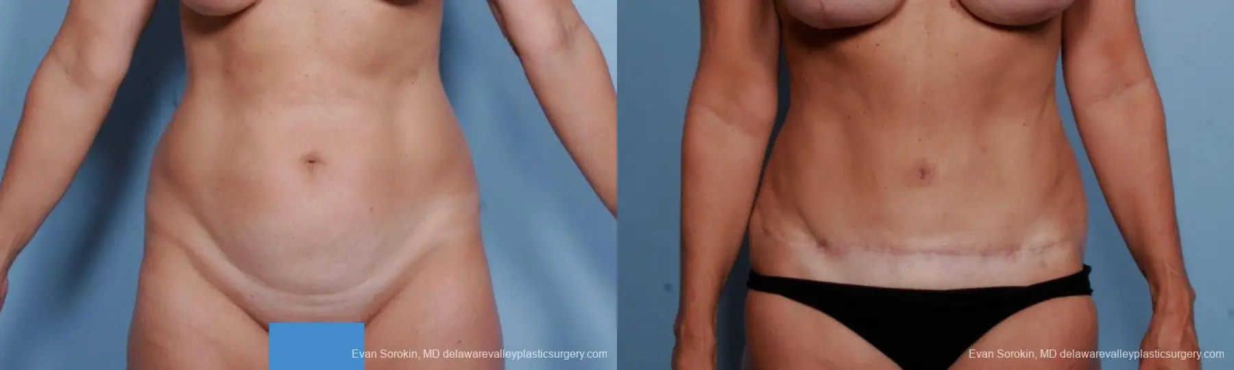 Philadelphia Abdominoplasty 9376 - Before and After 1