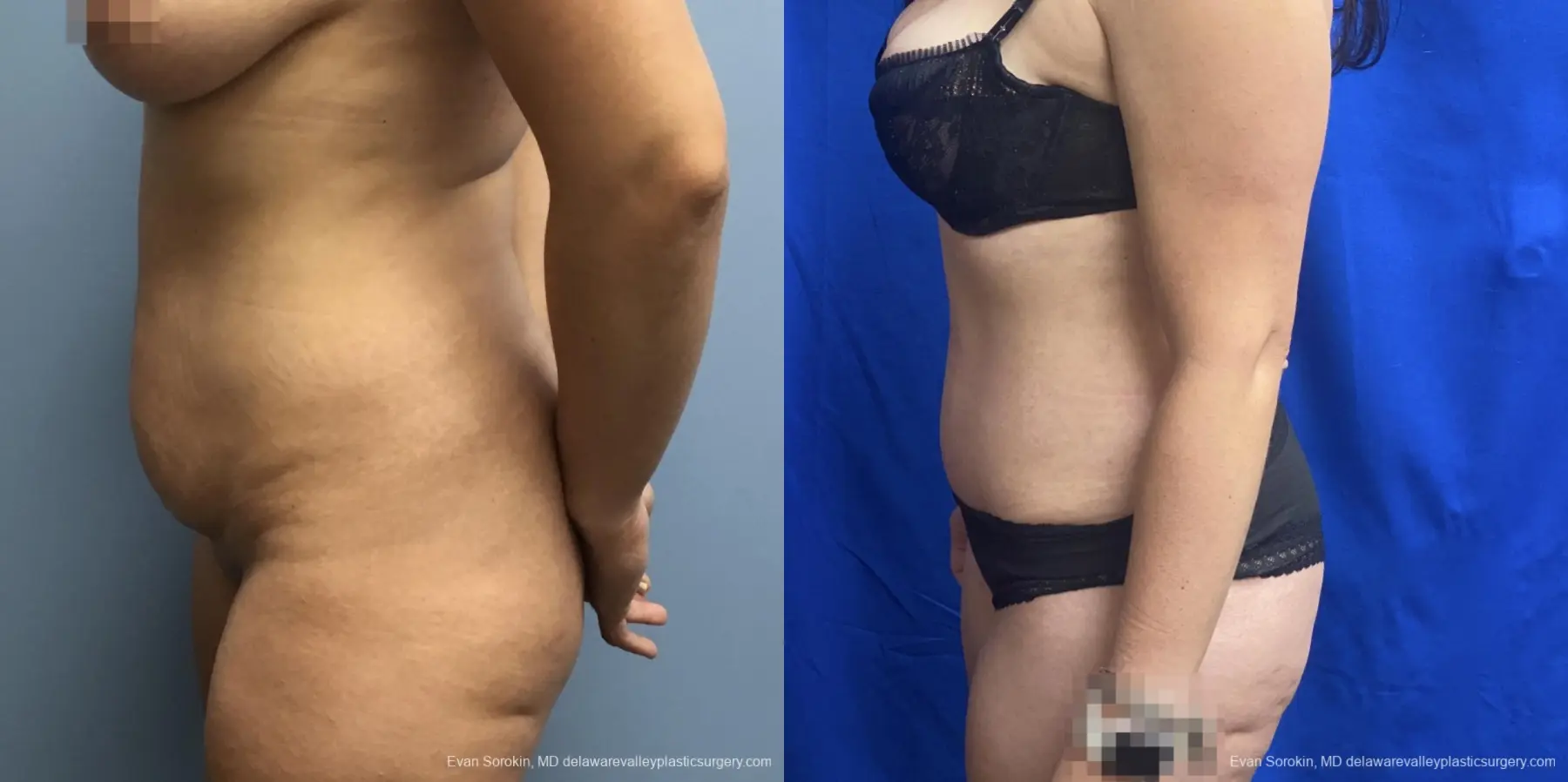 Abdominoplasty: Patient 35 - Before and After 5