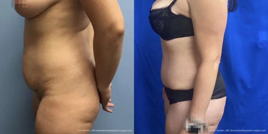 Abdominoplasty: Patient 35 - Before and After 5