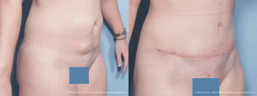 Philadelphia Abdominoplasty 9476 - Before and After 2