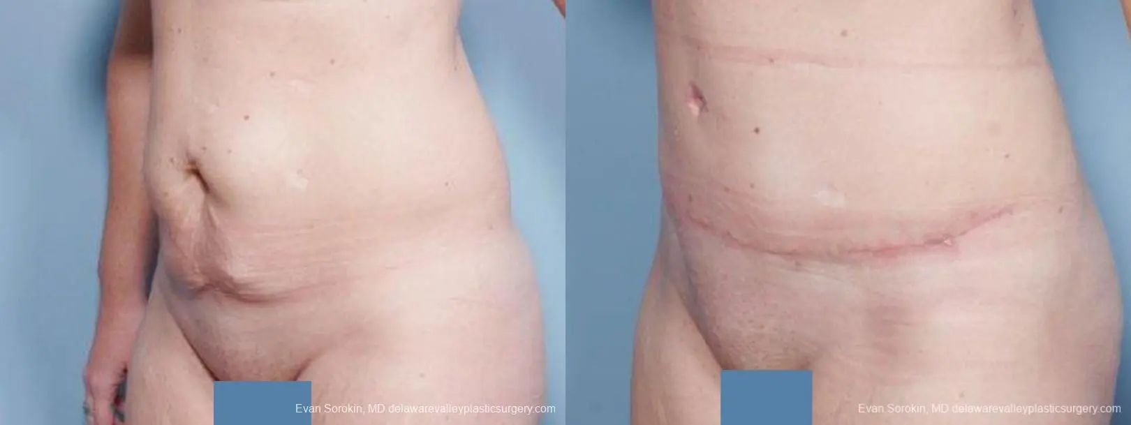 Philadelphia Abdominoplasty 9476 - Before and After 4