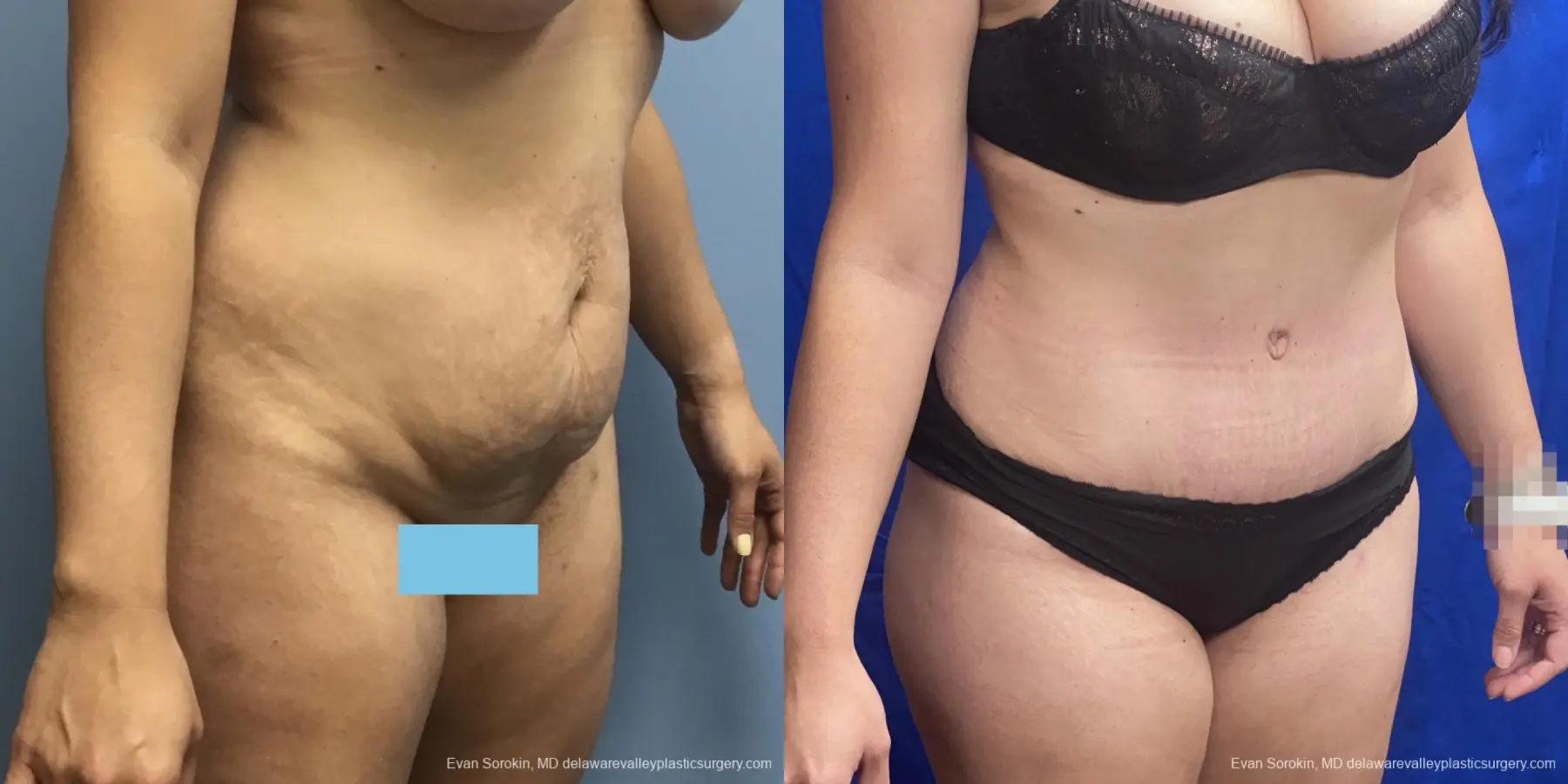 Abdominoplasty: Patient 35 - Before and After 2