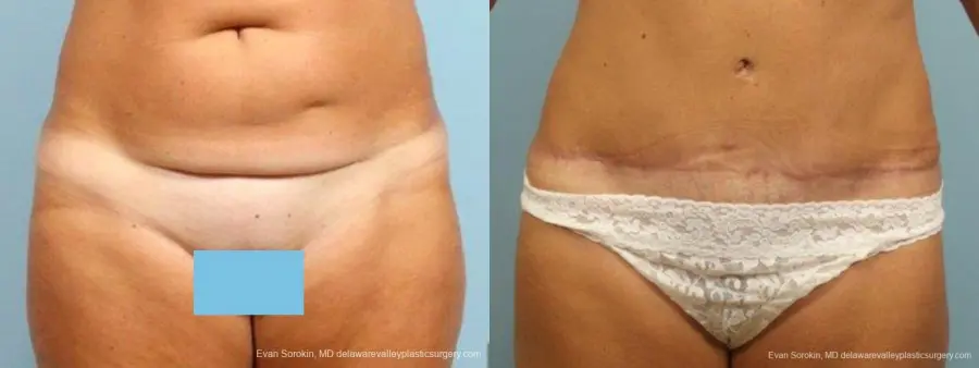 Philadelphia Abdominoplasty 9464 - Before and After 1