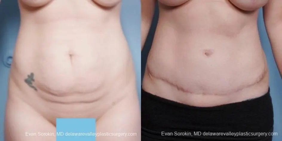 Philadelphia Abdominoplasty 8681 - Before and After 1