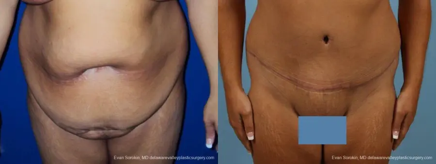 Philadelphia Abdominoplasty 9471 - Before and After 1