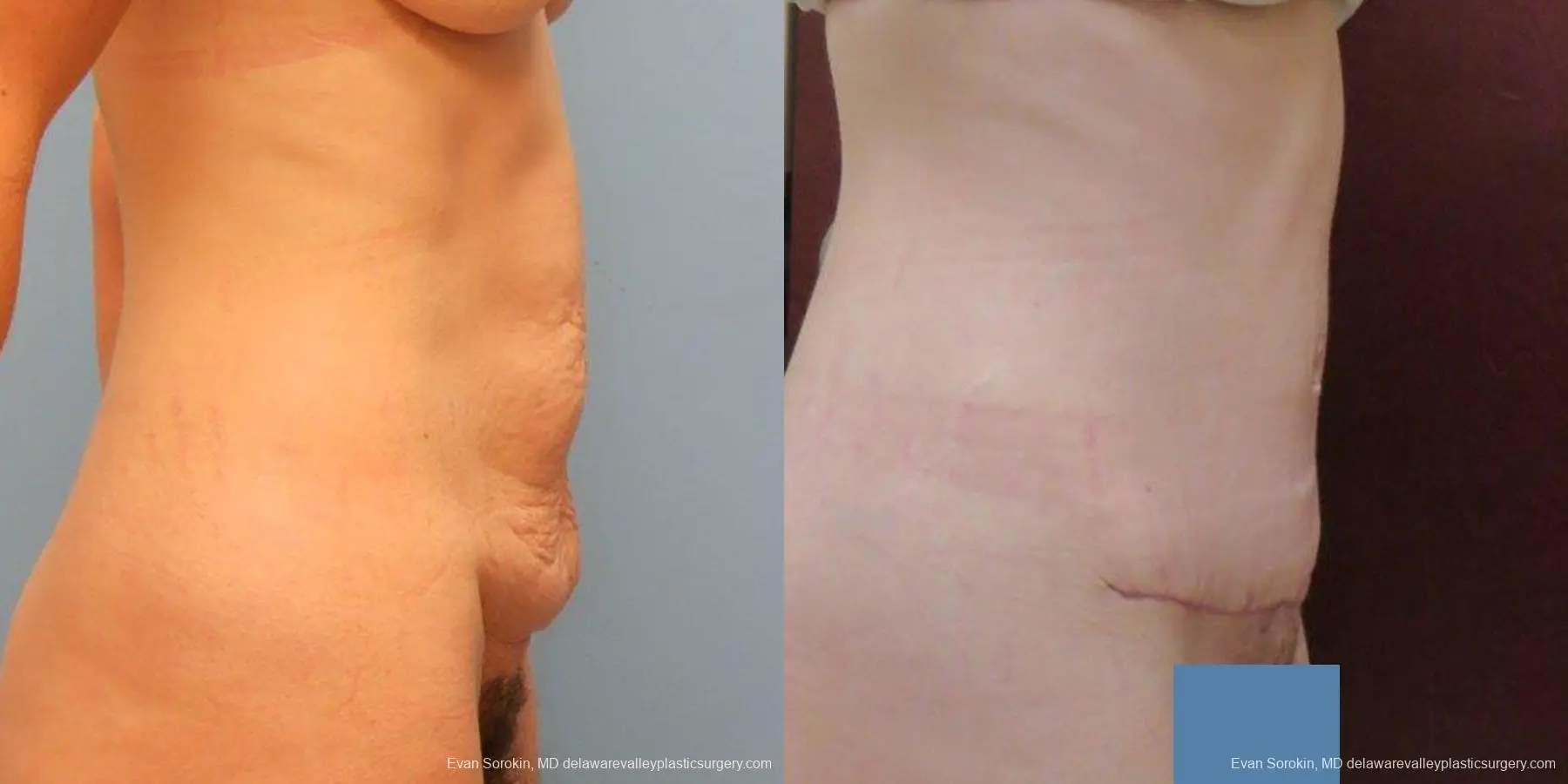 Philadelphia Abdominoplasty 9465 - Before and After 3