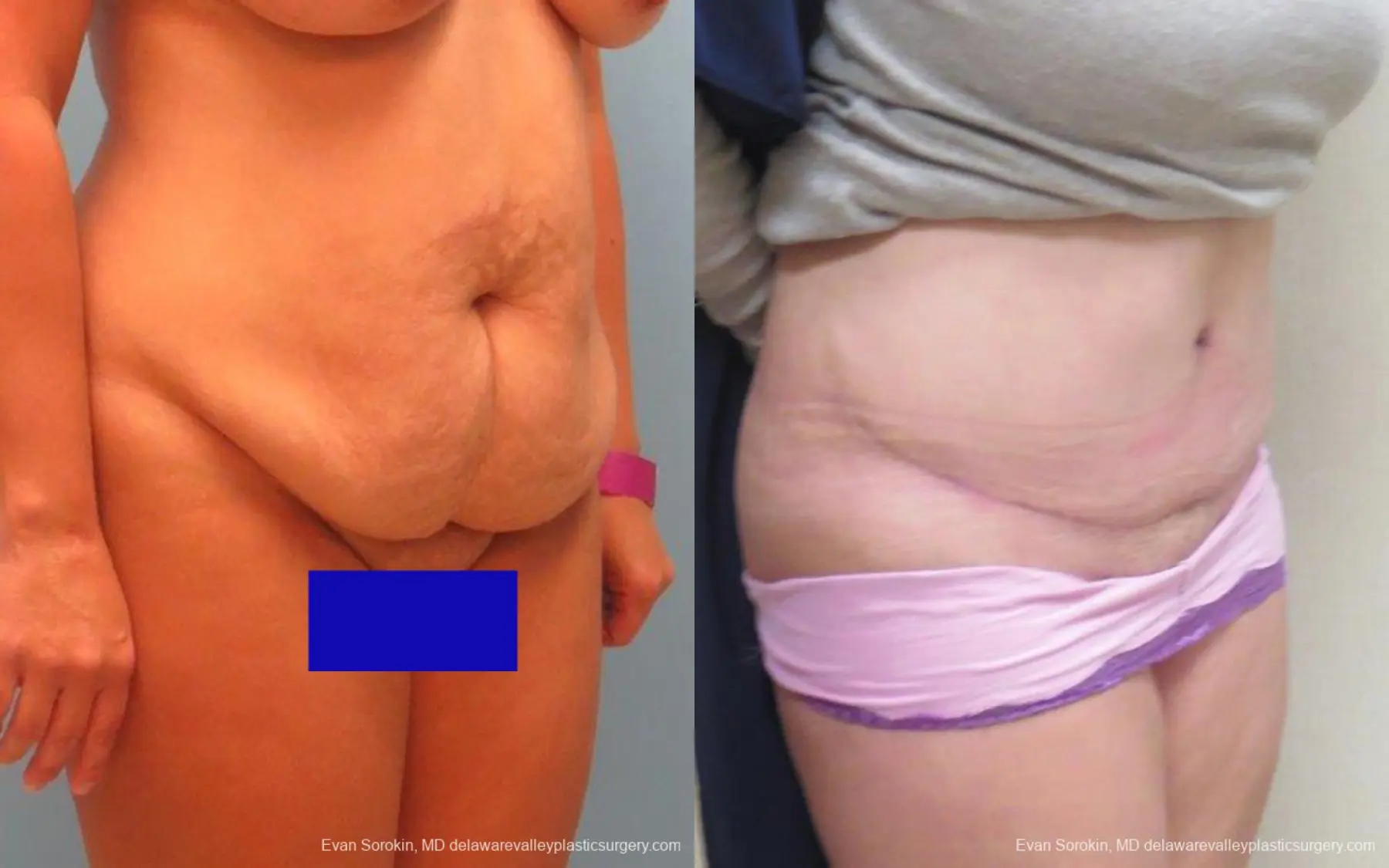 Philadelphia Abdominoplasty 9267 - Before and After 2