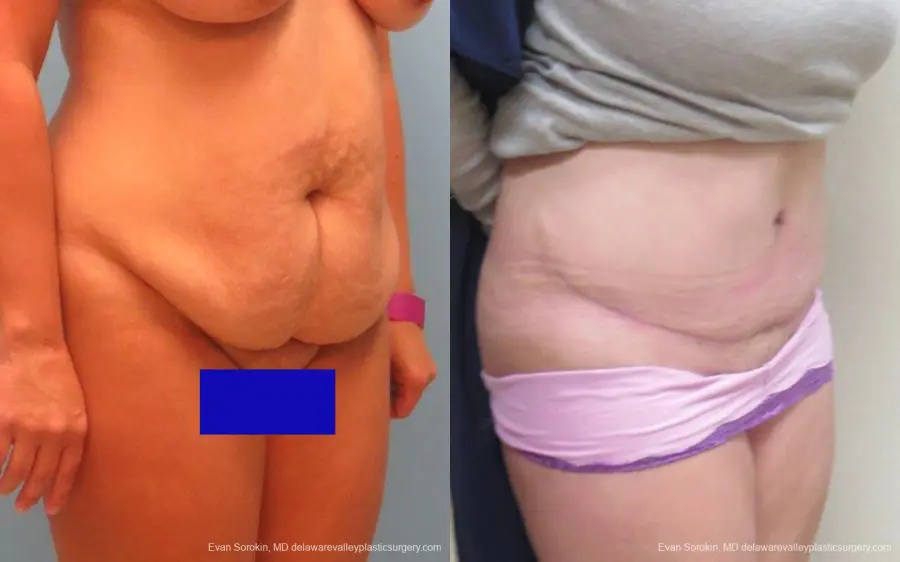 Philadelphia Abdominoplasty 9267 - Before and After 2