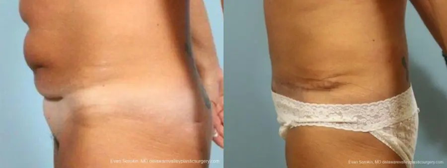 Philadelphia Abdominoplasty 9464 - Before and After 5