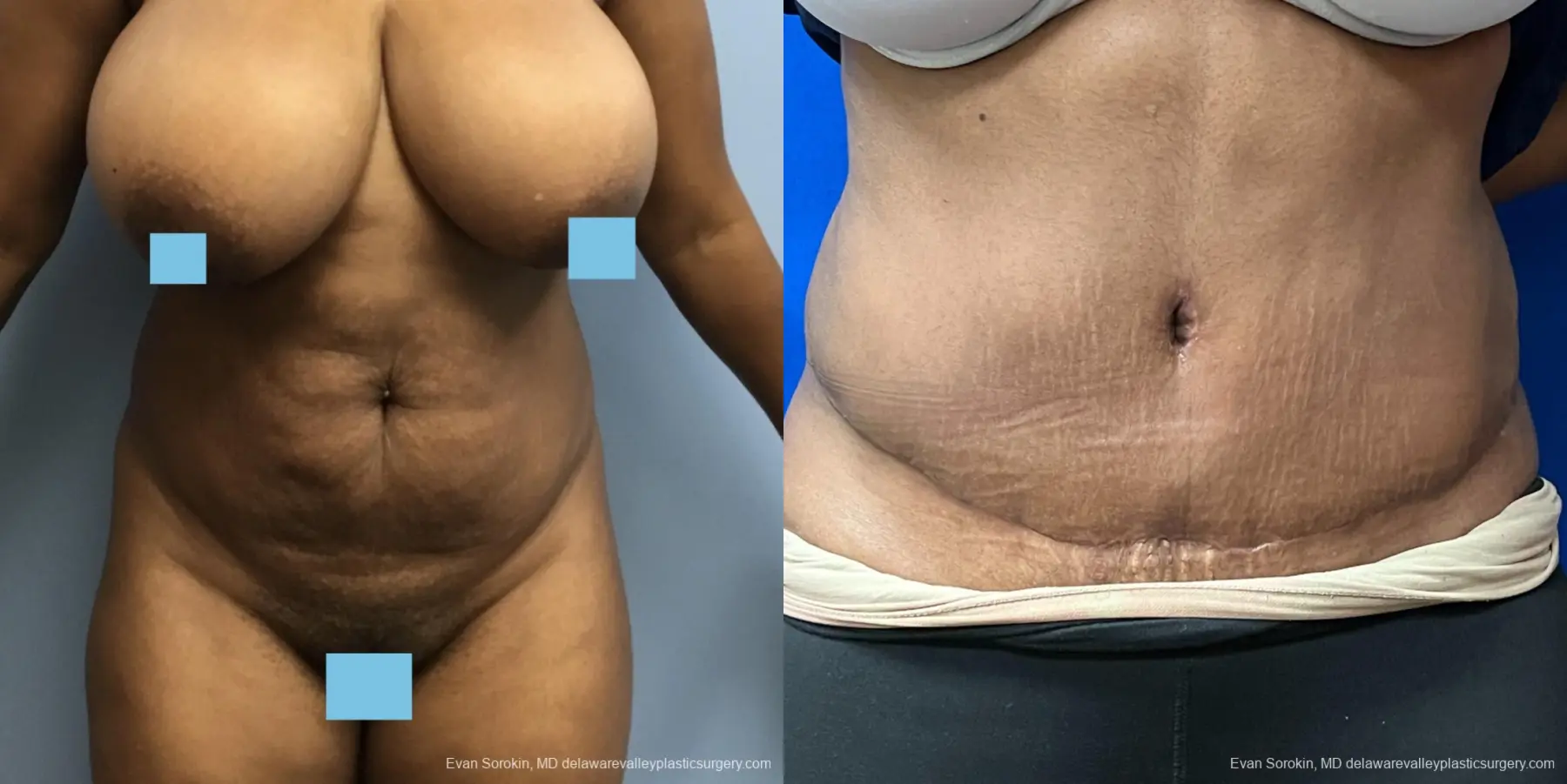 Abdominoplasty: Patient 39 - Before and After 1