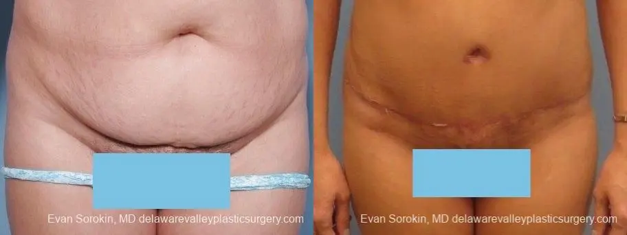 Philadelphia Abdominoplasty 8672 - Before and After 1