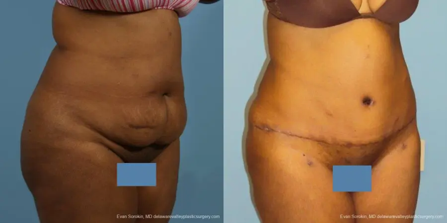 Philadelphia Abdominoplasty 9472 - Before and After 2