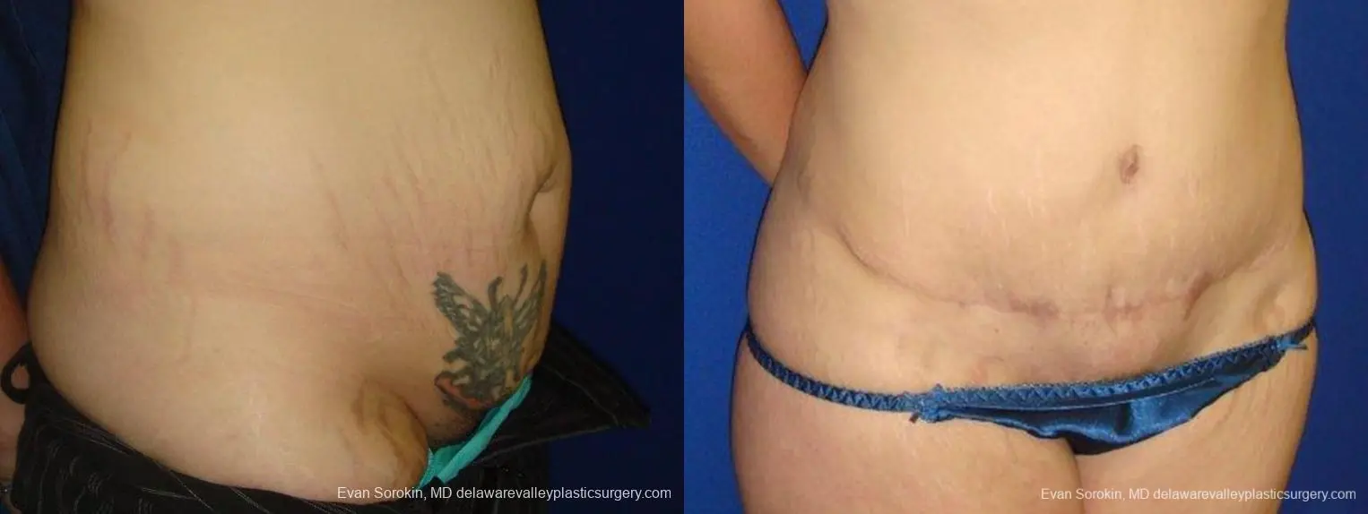 Philadelphia Abdominoplasty 9473 - Before and After 2