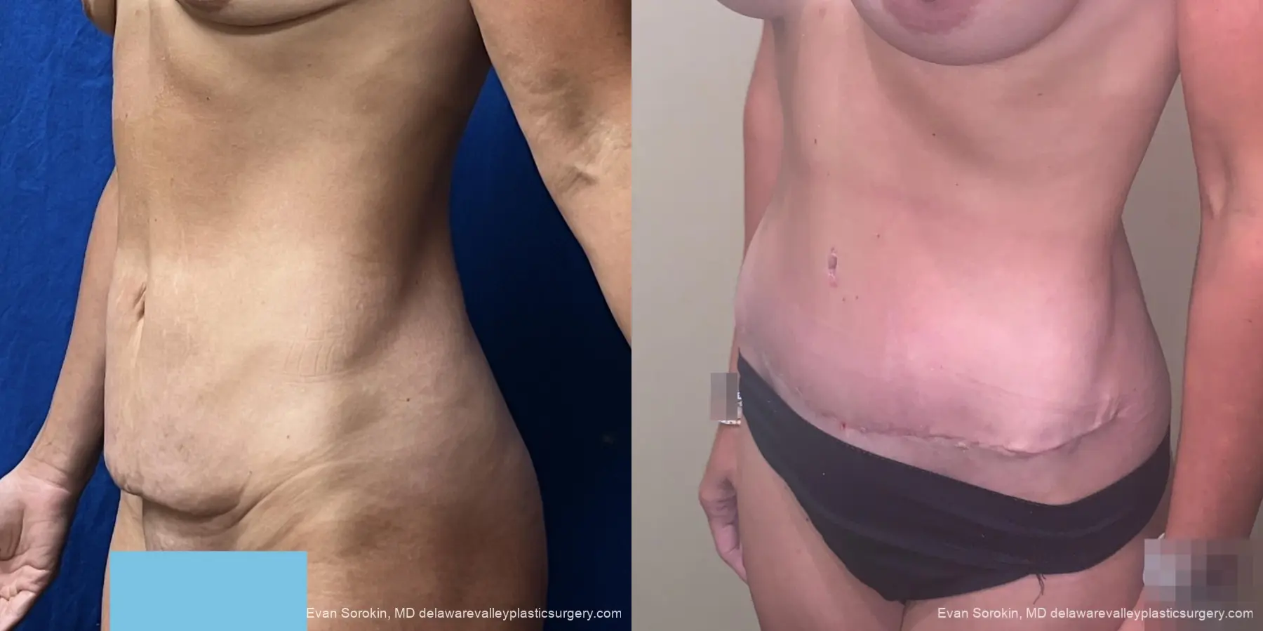 Abdominoplasty: Patient 3 - Before and After 4