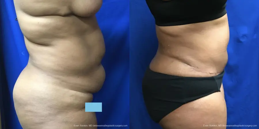 Abdominoplasty: Patient 34 - Before and After 3