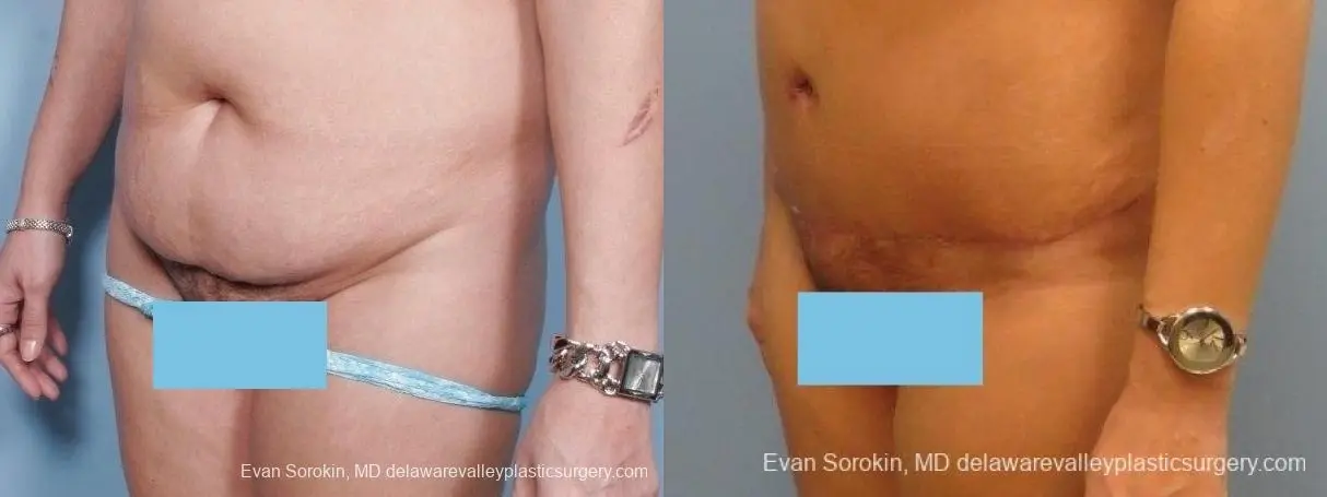 Philadelphia Abdominoplasty 8672 - Before and After 3