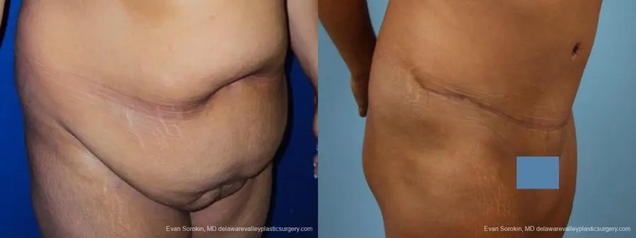 Philadelphia Abdominoplasty 9471 - Before and After 2