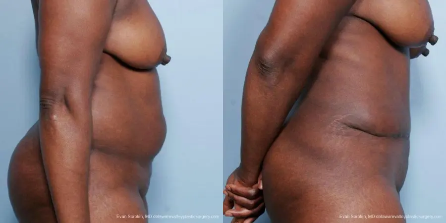 Philadelphia Abdominoplasty 9477 - Before and After 3