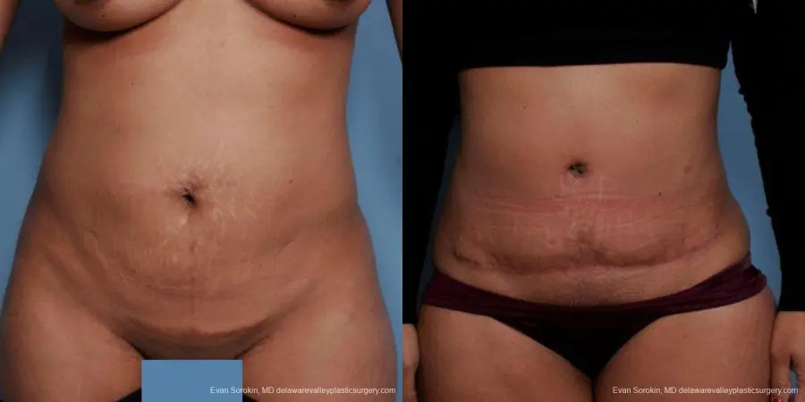 Philadelphia Abdominoplasty 9479 - Before and After 1