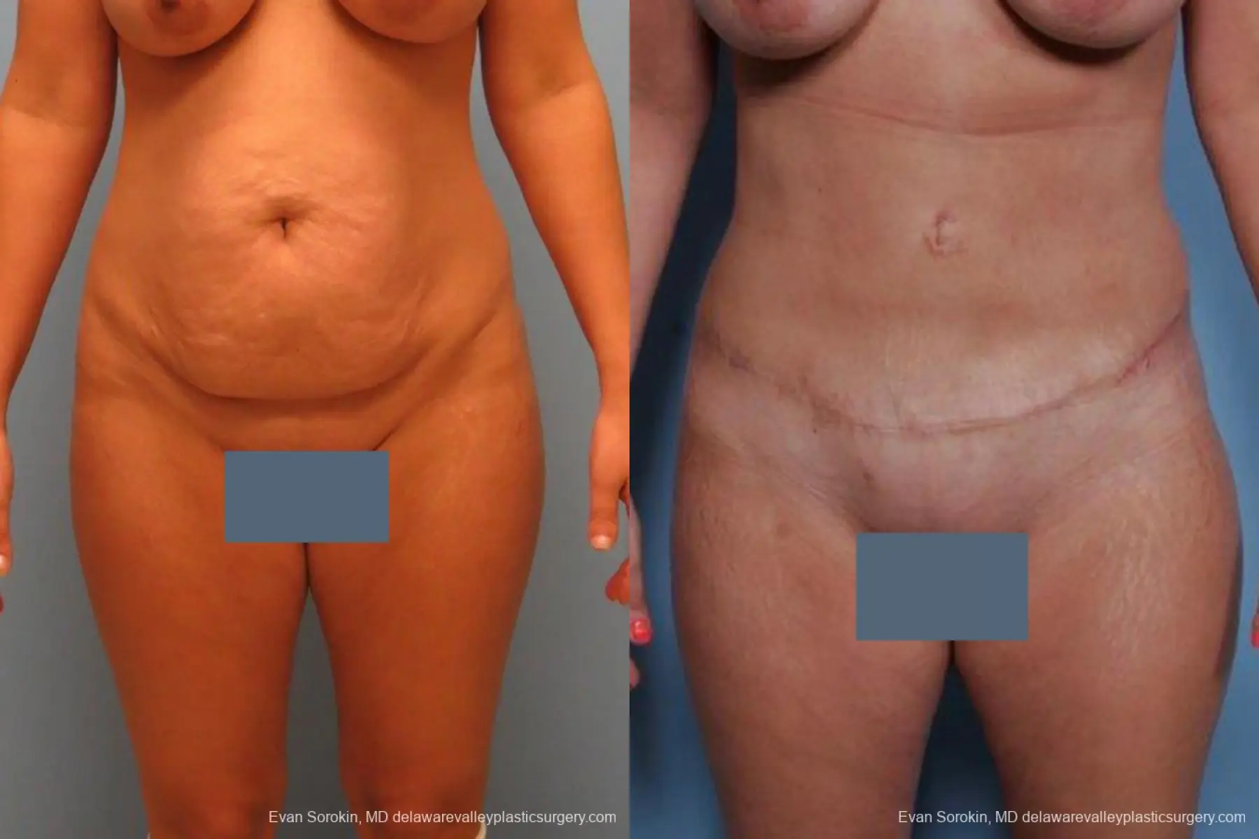 Philadelphia Abdominoplasty 9460 - Before and After 1