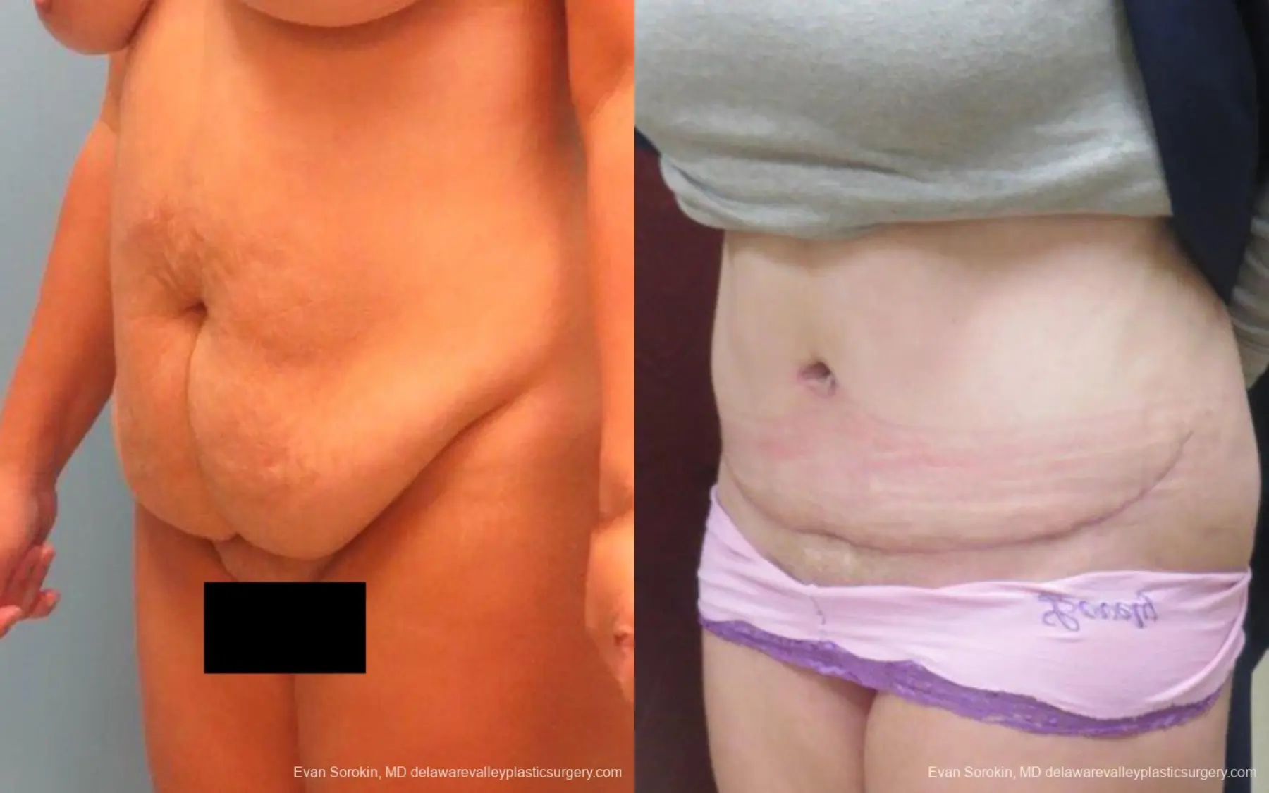 Philadelphia Abdominoplasty 9267 - Before and After 4