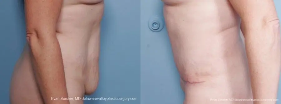 Philadelphia Abdominoplasty 9315 - Before and After 3
