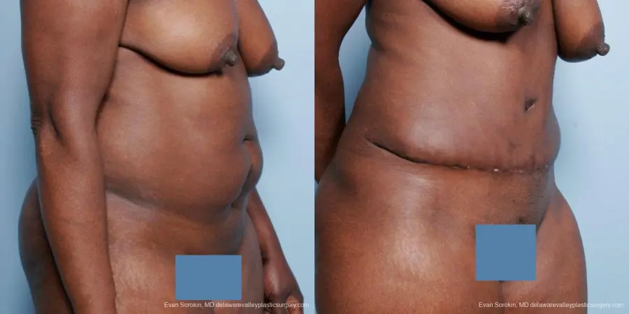 Philadelphia Abdominoplasty 9477 - Before and After 2