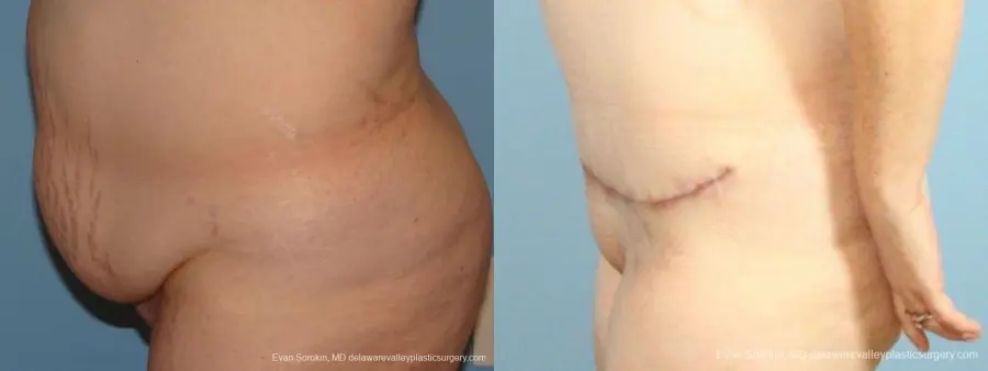 Philadelphia Abdominoplasty 9467 - Before and After 5